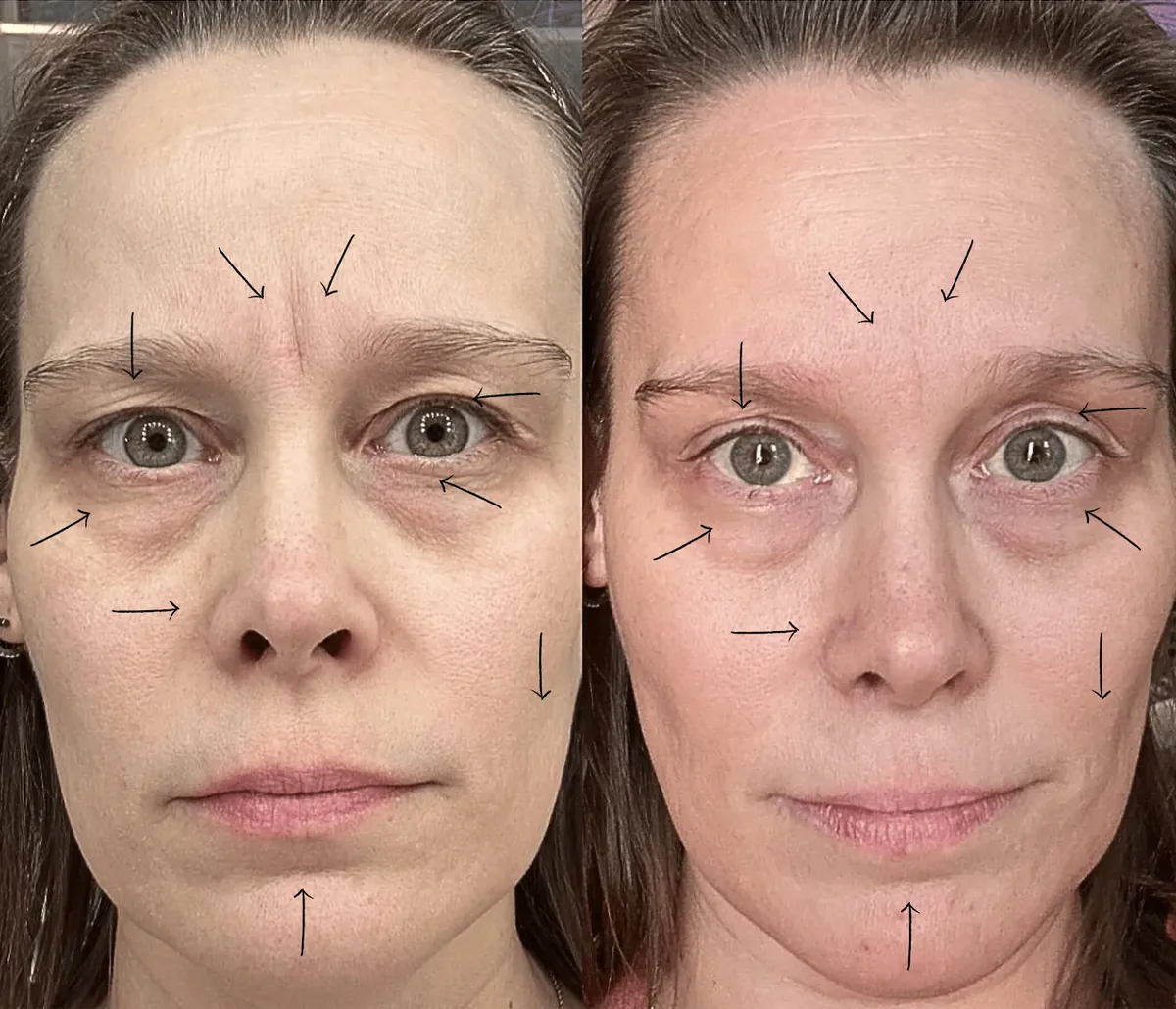 Amanda's 11 line disappeared, undereyes brightened, nasolabial folds lessened, and hooded eyes lifted in 14 days