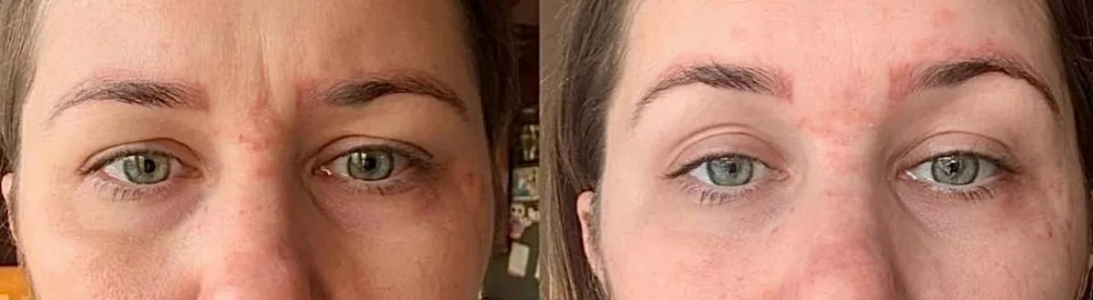 Before and after pics of Madison's eyelids completely lifted