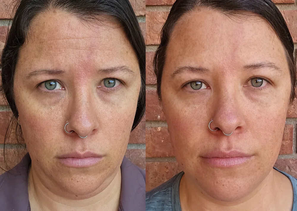 Before and after pics of Phoebe's smoothed forehead and de-puffed neck