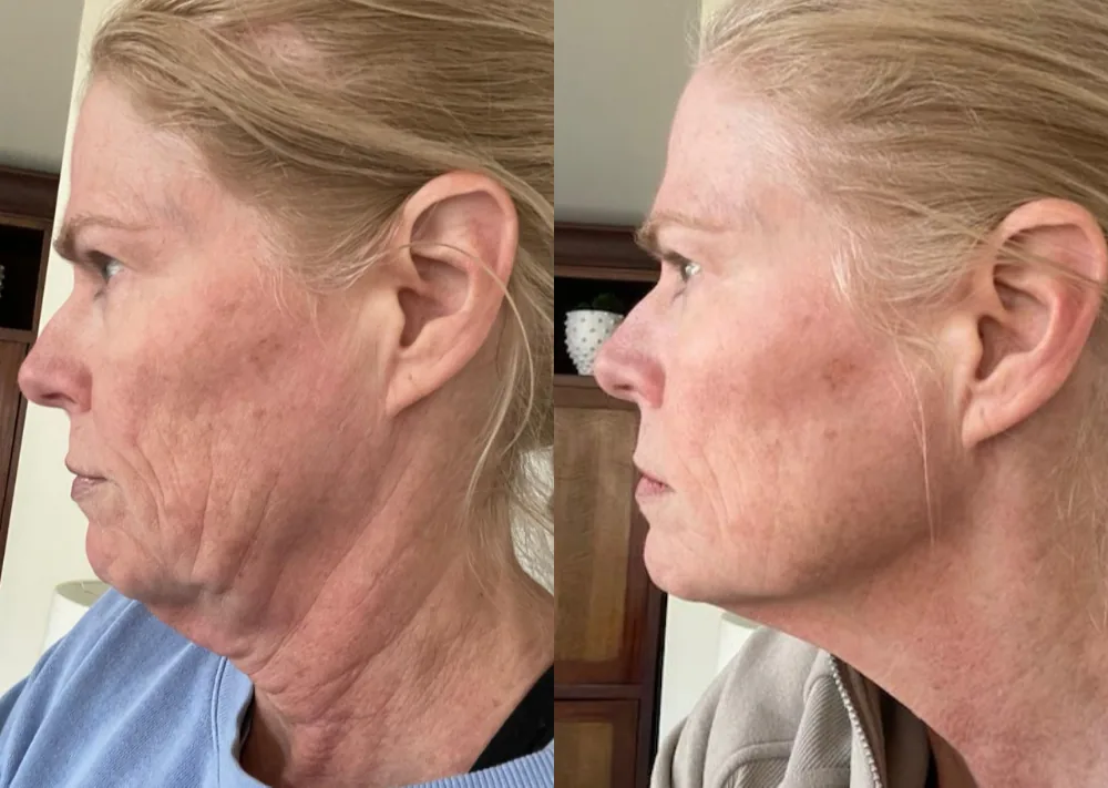 Before and after pics of Stephanie's lower face and neck lift