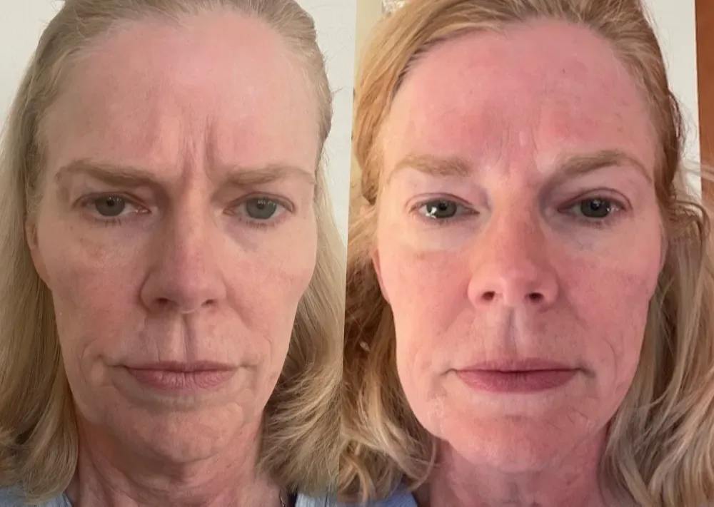 Before after pics of Stephanie's smoothed and lifted face