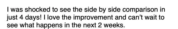 Message: I was shocked to see the side by side comparison in just 4 days! I love the improvement and can't wait to see what happens in the next 2 weeks.