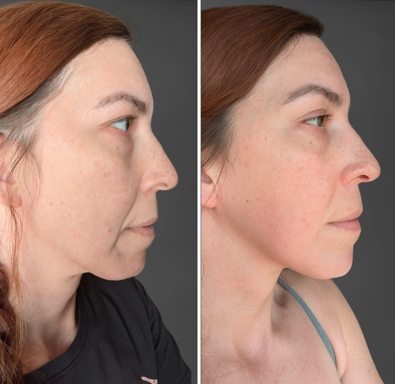 Kellie before and after: hooded eyelids, nasolabial folds and jawline, side profile