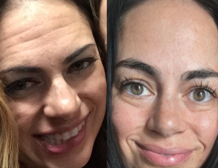 Allison before and after