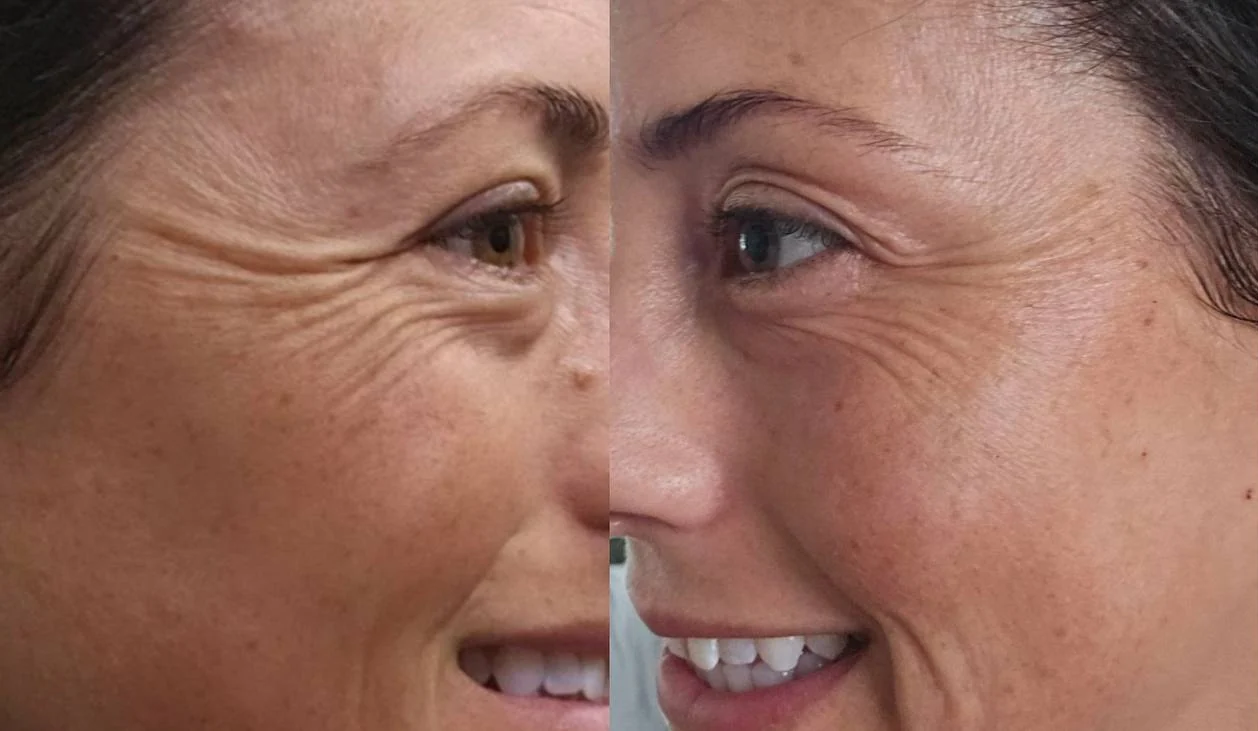Before and after, close side view of a woman's eye and crow's feet, before on the left, after on the right